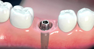 Προσθετική Οδοντιατρική - Εμφυτεύματα